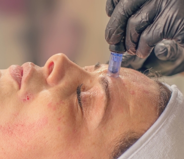 Dermapen Microneedling 